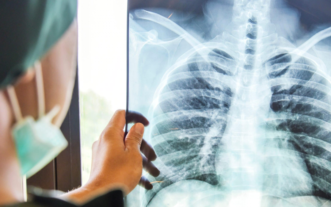 Cancer Care Milestones