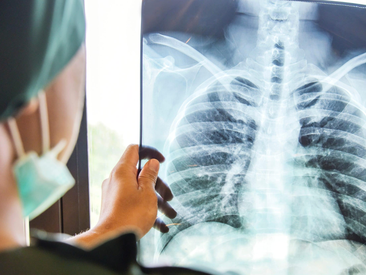 Cancer Care Milestones